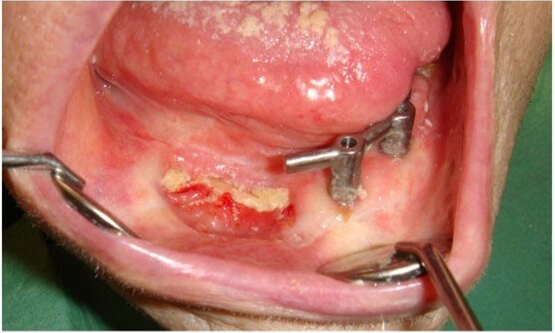 What is mandibular osteoradionecrosis?