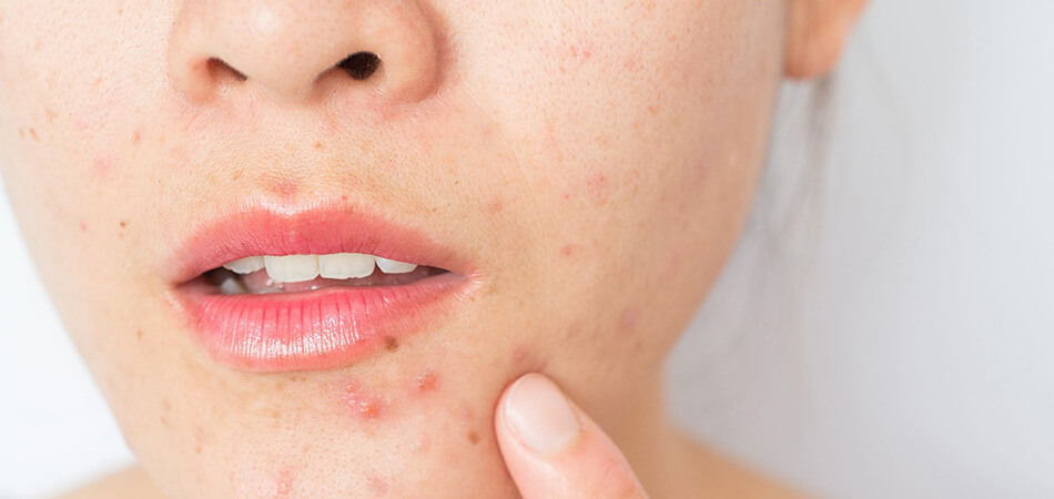 La thérapie par oxygène hyperbare dans le traitement des infections cutanées