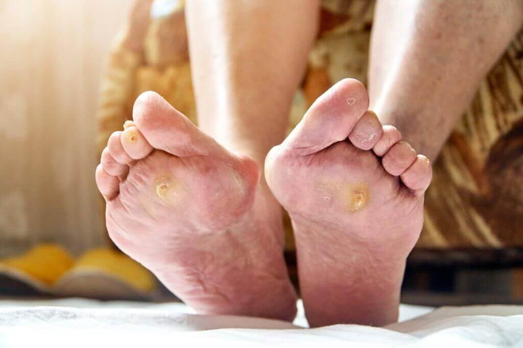Quels sont les symptômes du pied diabétique ?