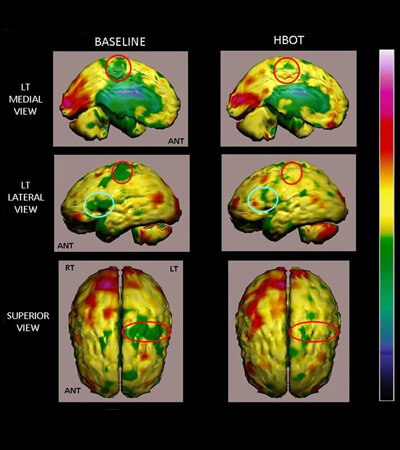 Patients post-AVC