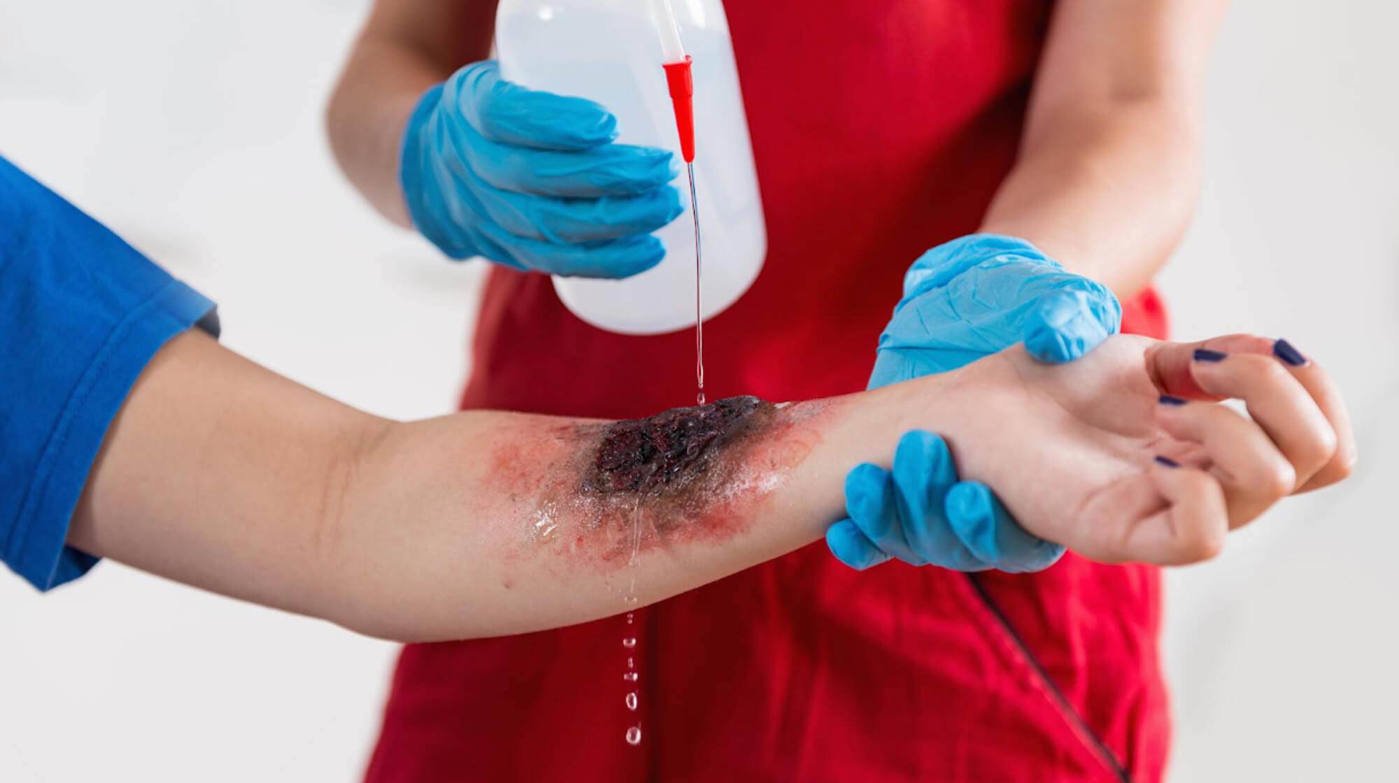 Hyperbare Therapie: Eine Innovation in der Behandlung schwerer Verbrennungen