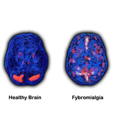 Fibromyalgie oder Fibromyalgie-Syndrom