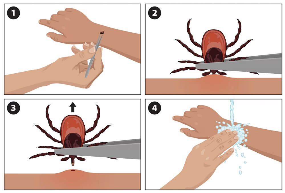 Tick Removal