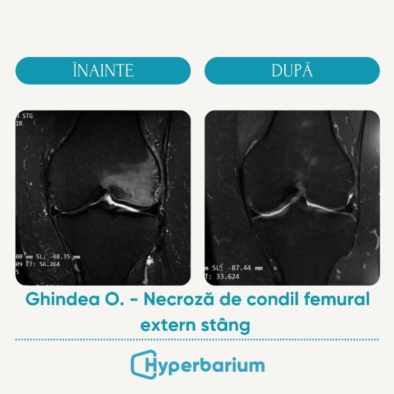 Revolutionary technique for treating necrosis