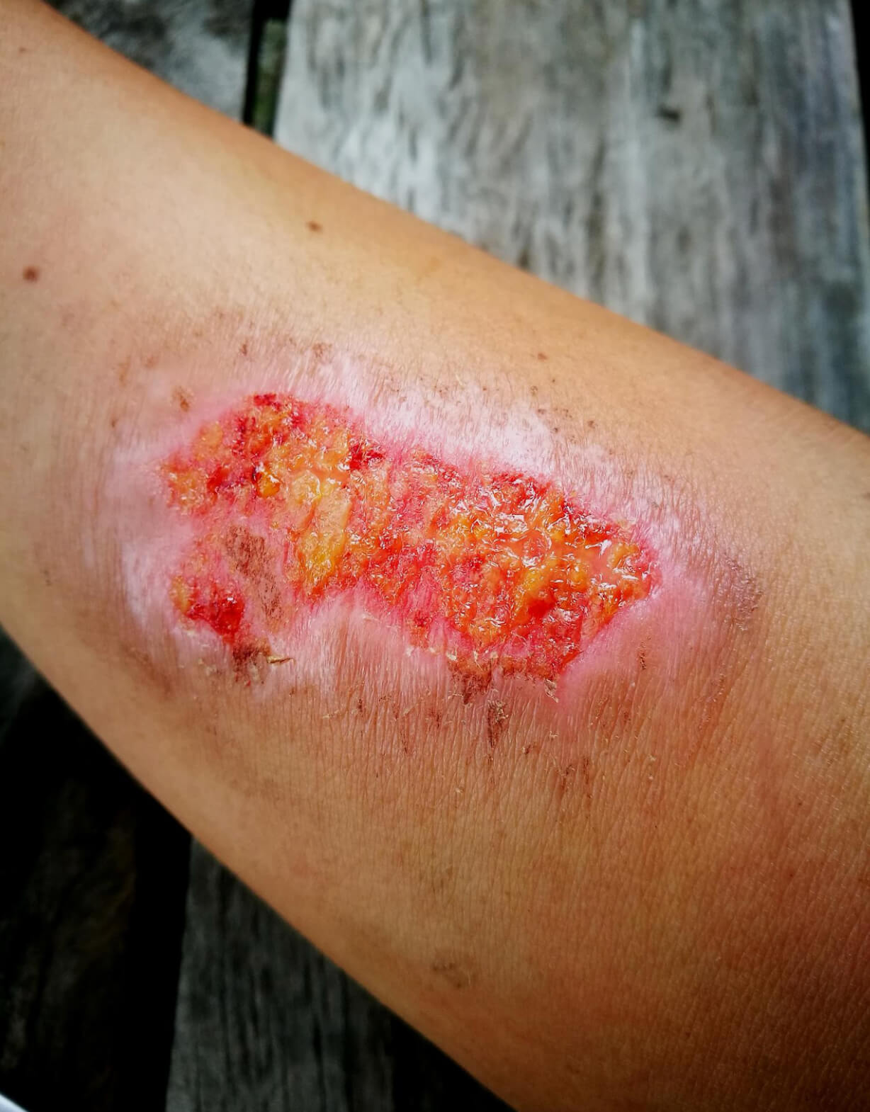 Hyperbaric therapy for severe burns: past and present