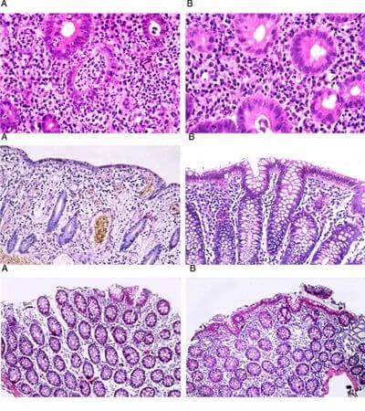 Inflammatory bowel diseases