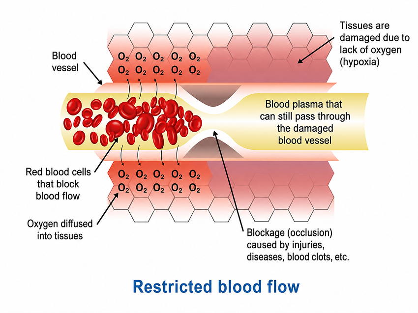 Restricted blood flow