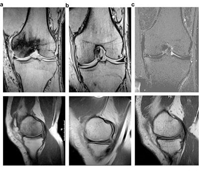 Aseptic bone necrosis