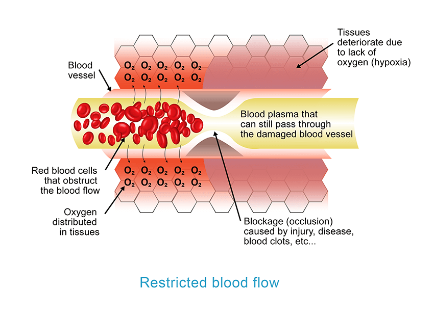 Restricted blood flow