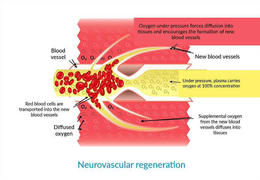 Hyperbaric Oxygenation