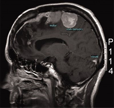 Adjuvant antitumour treatment