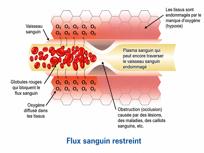 Flux sanguin restreint