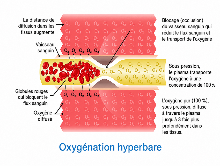 Oxygénation hyperbare