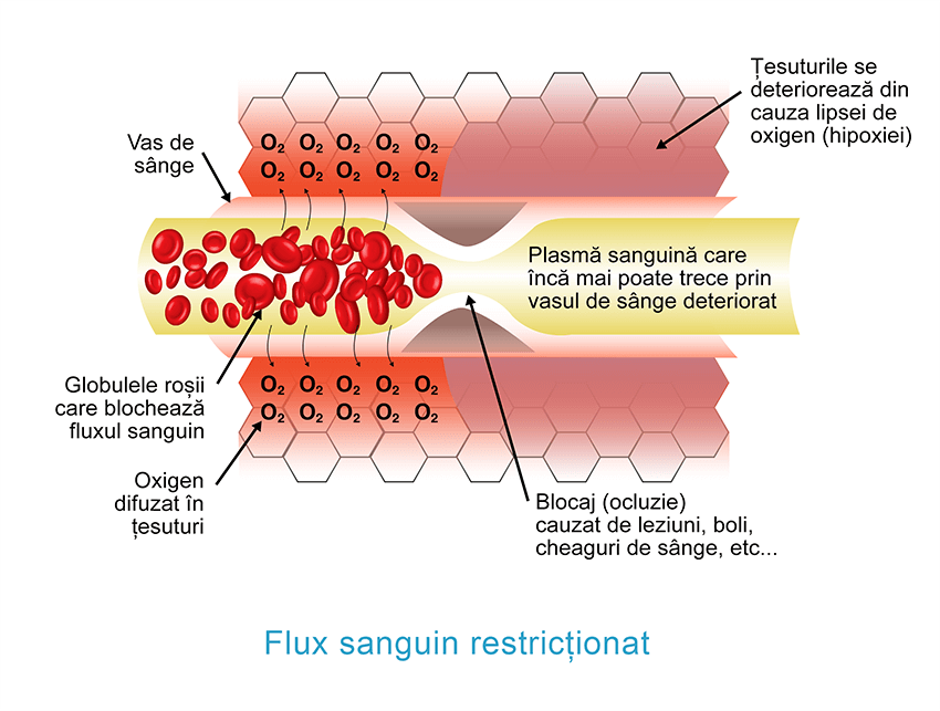 Flux sanguin restreint