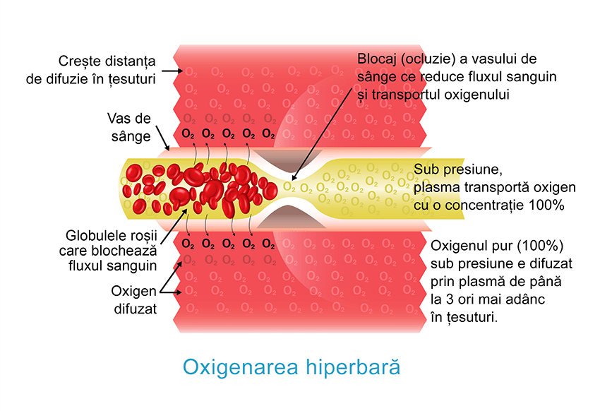 Oxygénation hyperbare