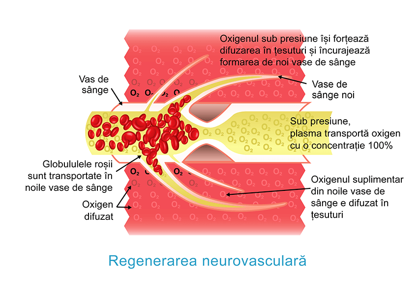 Oxygénation hyperbare