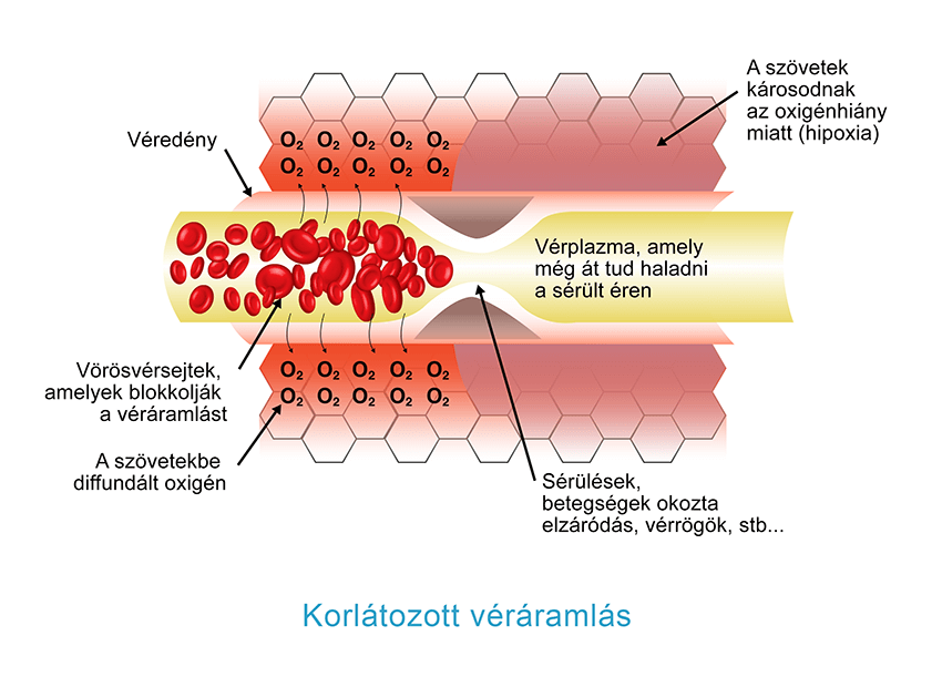 Korlátozott véráramlás