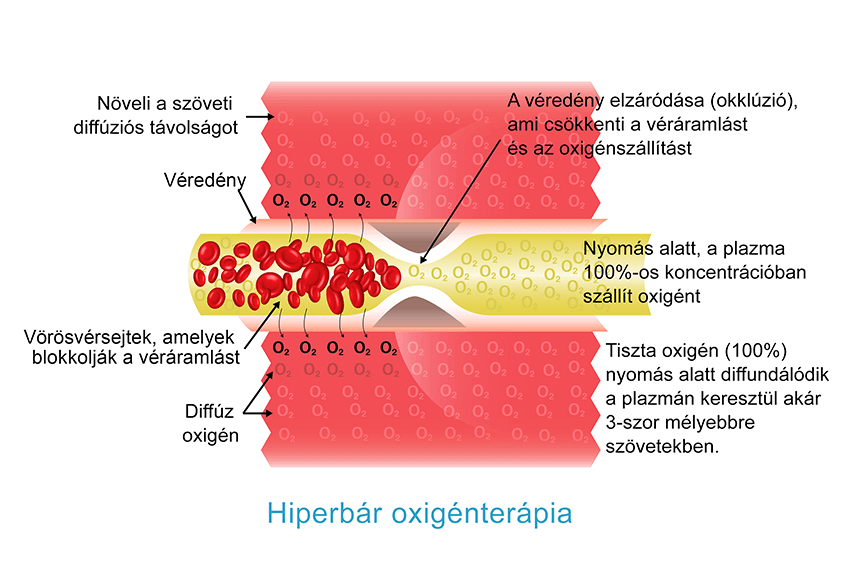 Hiperbár oxigénellátás