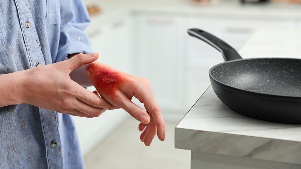 Tutto sulle ustioni: tipi, trattamenti e recupero