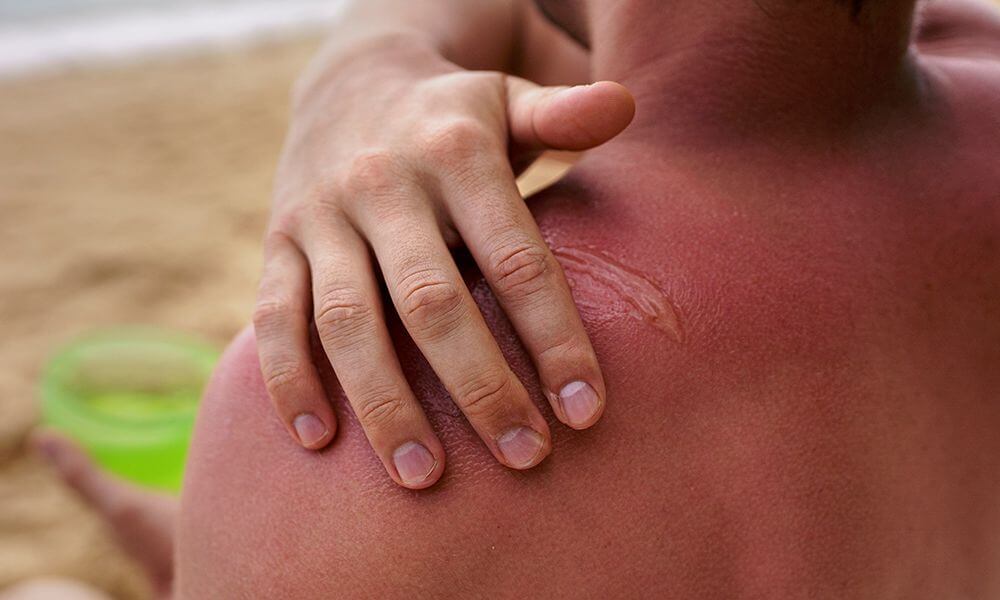 Ustioni da radiazione