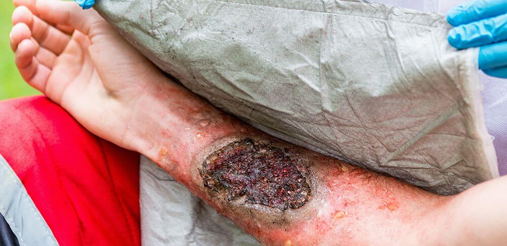 Complicanze delle ustioni