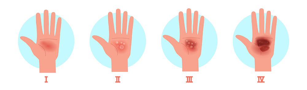 Tipi di ustioni in base alla gravità