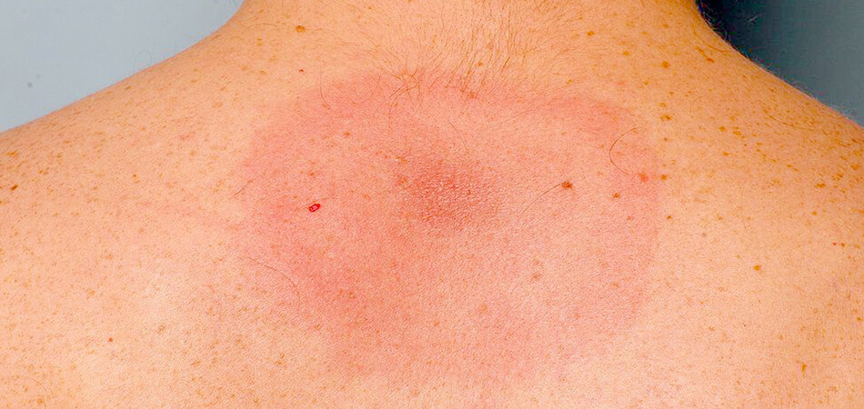 Terapia con ossigeno iperbarico nel trattamento della malattia di Lyme