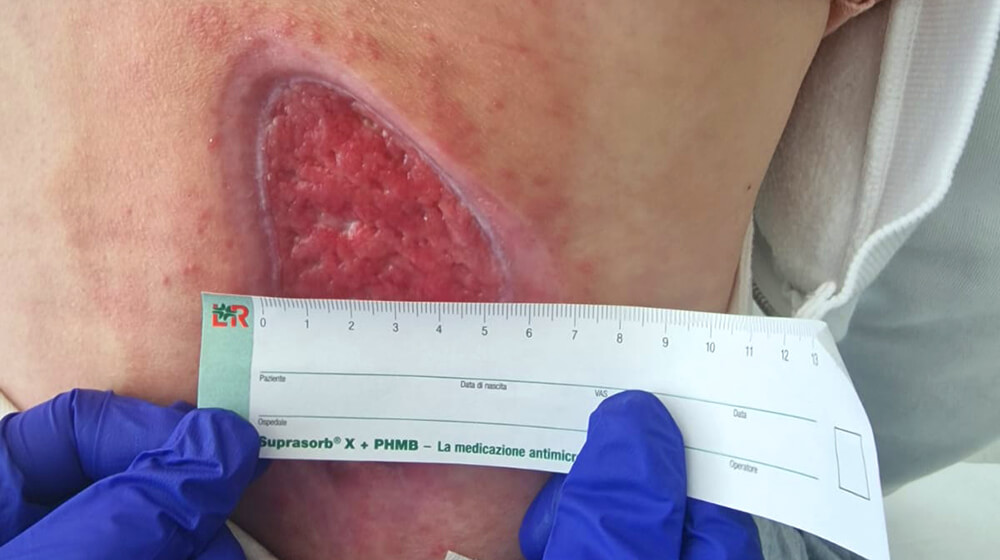 Ferite che non guariscono: cause, sintomi e trattamento