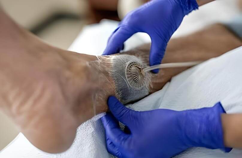 Terapia a Pressione Negativa