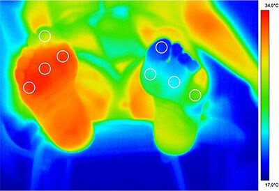 Complicanze del diabete