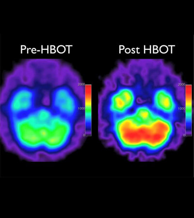 Disfunzione erettile