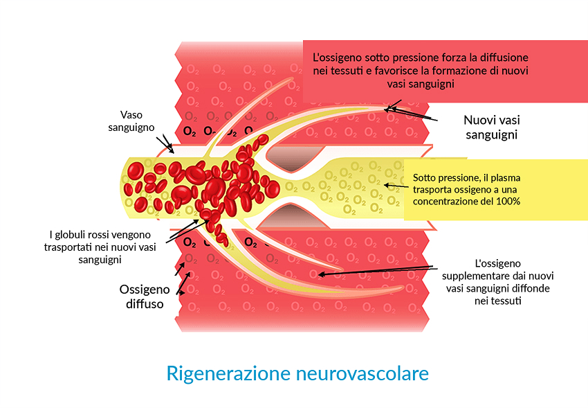 Ossigenazione iperbarica