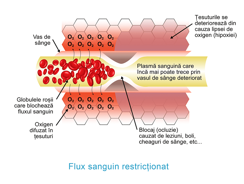 Flux sanguin restricționat