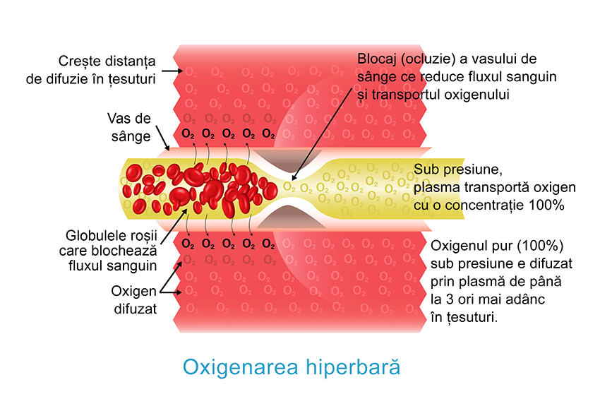 Oxigenarea Hiperbară