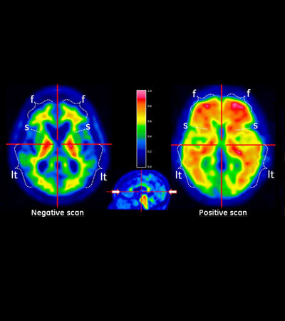 Sindrom de stres posttraumatic